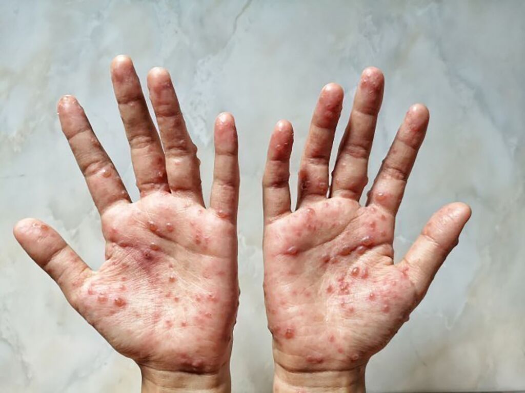 Les États-Unis enregistrent plus de 26.000 cas de variole du singe