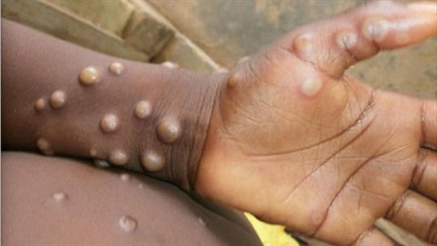 Chile confirms its first case of monkeypox